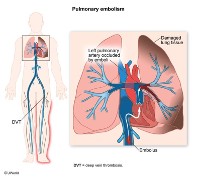 Pulmonary-embolism
