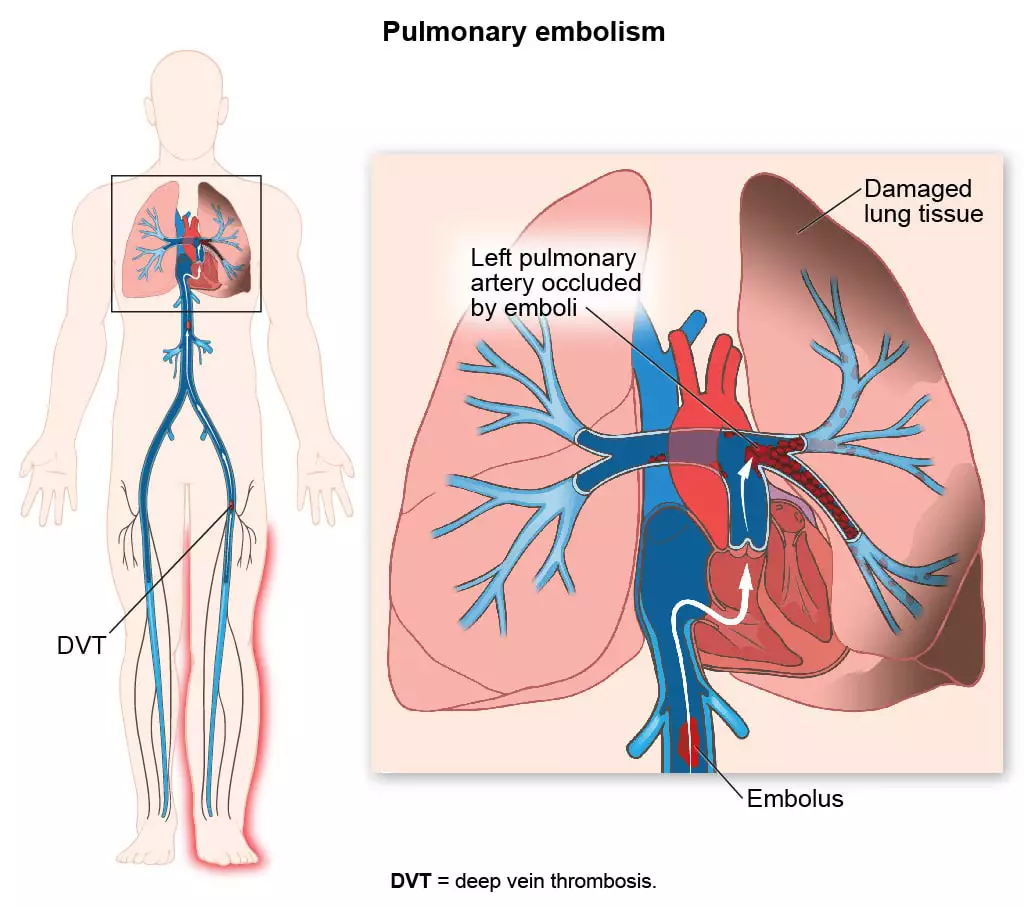 Image of pulmonary embolism from UWorld’s Learning Platform for Nursing.