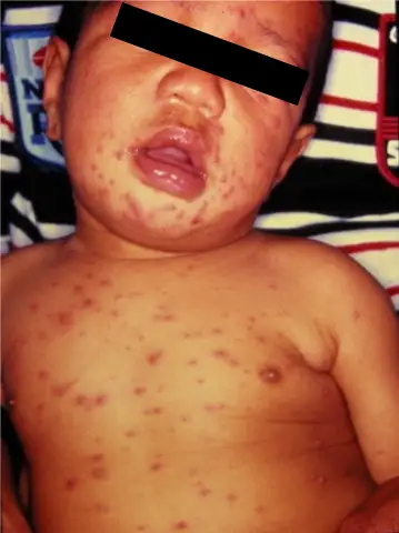 Clinical Image of child with varicella from UWorld’s Learning Platform for Nursing.