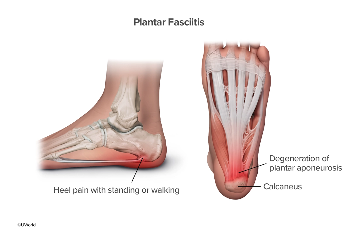 FNP practice question explanations for visual learners - Plantar Fasciitis