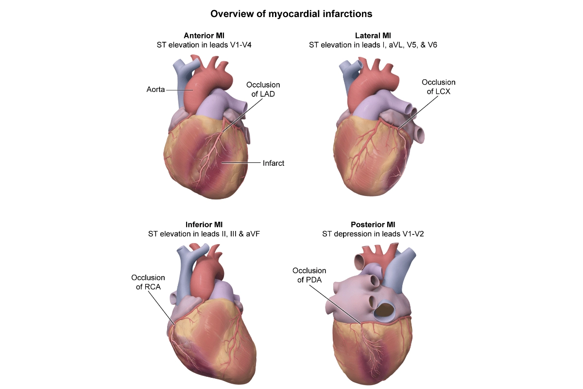 FNP practice question explanations for visual learners - Myocardial infarctions
