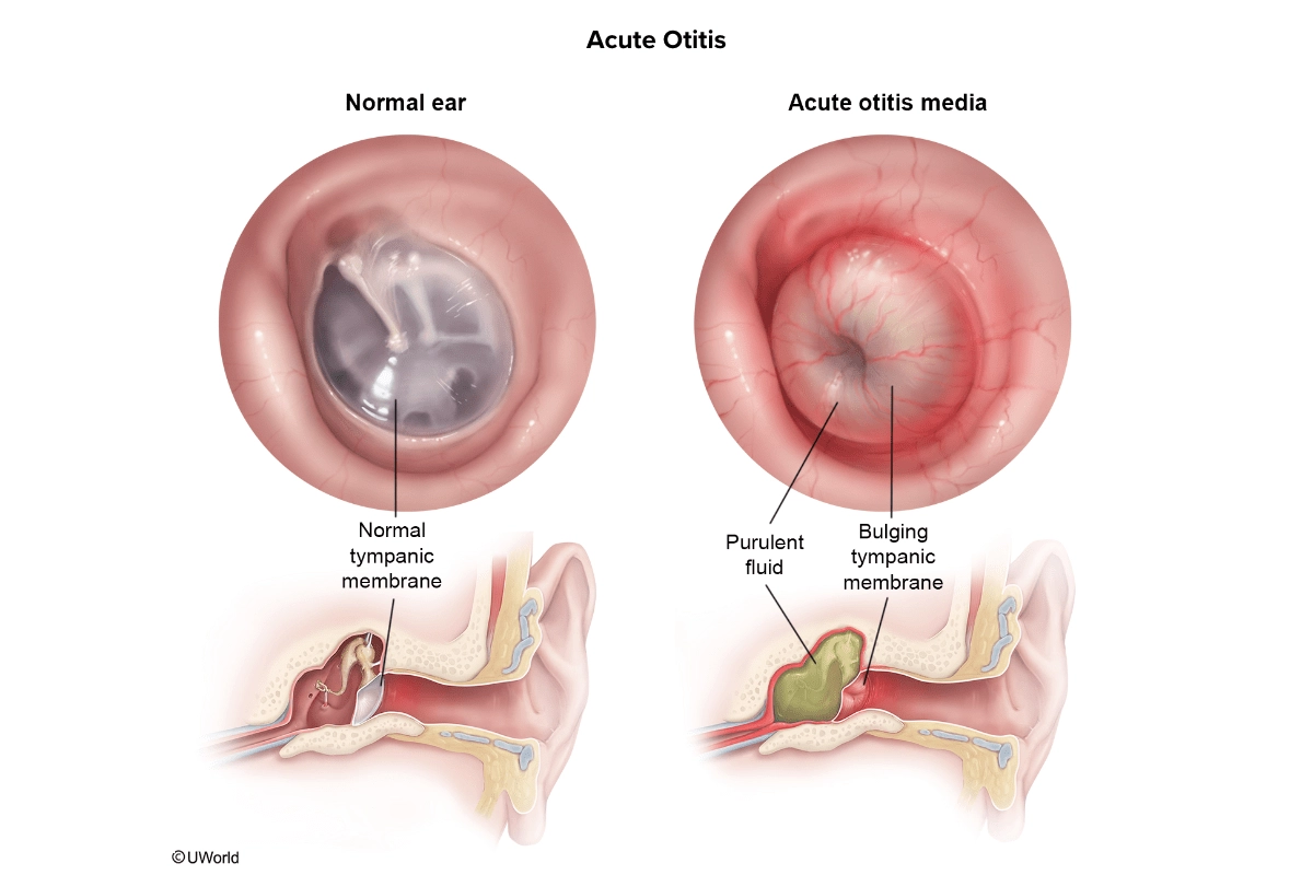 FNP practice question explanations for visual learners - Acute Otitis
