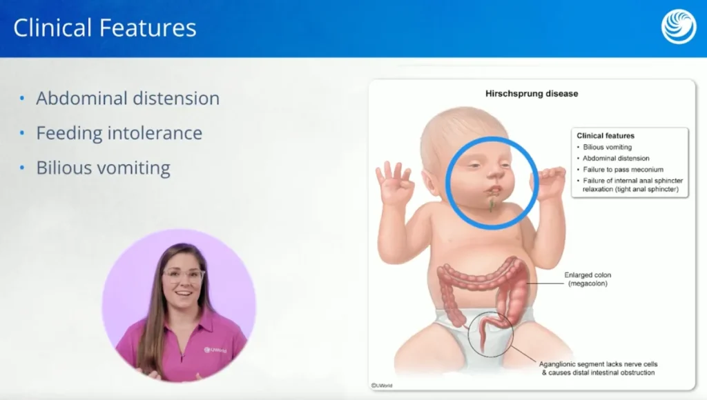 UWorld Nursing lecture video on Hirschsprung disease symptoms